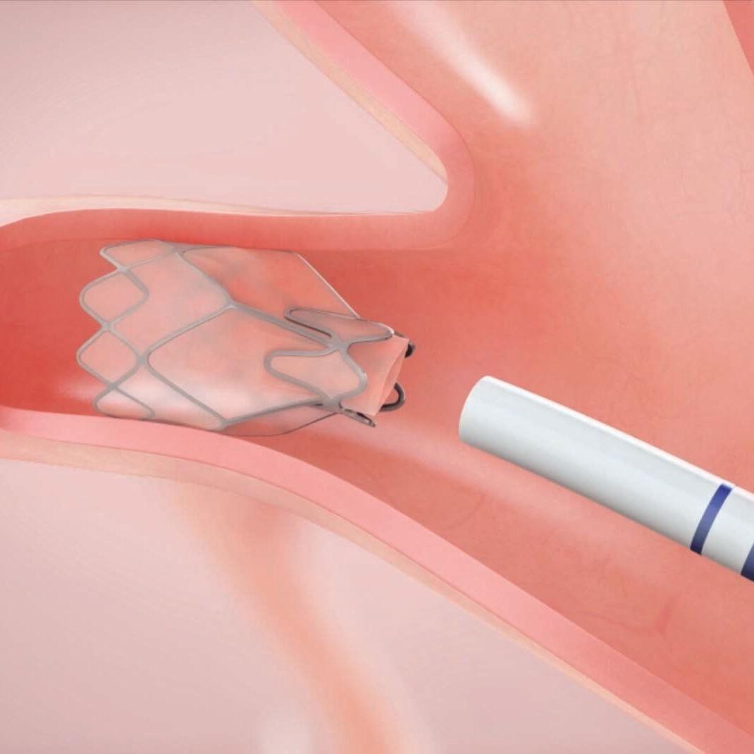 COPD TREATMENT PREVENTS TRANSPLANT FOR LOUISVILLE WOMAN 11-18-2021  (1).jpg